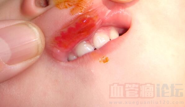 我女儿上唇里面长了血管瘤，怎么办啊？、？_血管瘤论坛-中国血管瘤患者之家