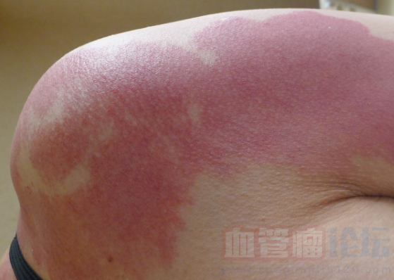 鲜红斑痣会带来哪些危害？_血管瘤论坛-中国血管瘤患者之家