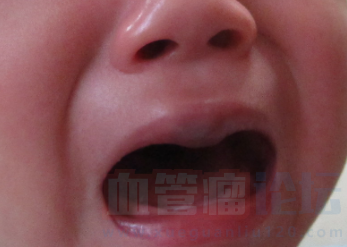 这两天发现我家宝宝嘴唇上长了个血管瘤，这可如何是..._血管瘤论坛-中国血管瘤患者之家