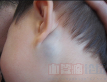 谁知道这个血管瘤怎么办呀？？？我家孩子耳朵后面有一..._血管瘤论坛-中国血管瘤患者之家