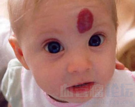 宝宝头上长了血管瘤，危险吗_血管瘤论坛-中国血管瘤患者之家