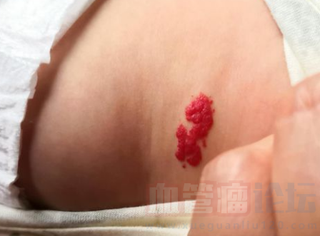 宝宝出生2周不到腰部出现指甲盖大小的红色块状物是血管瘤_血管瘤论坛-中国血管瘤患者之家