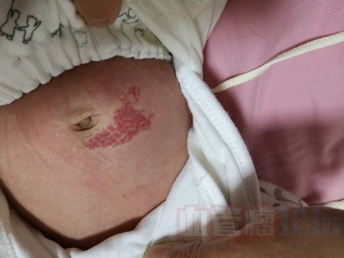 帮忙看一下宝宝的血管瘤属于哪一种，能自己消退吗？_血管瘤论坛-中国血管瘤患者之家