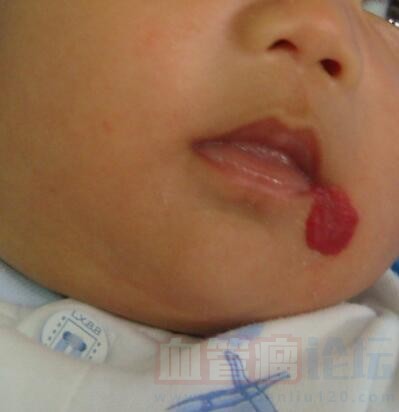 我家宝宝的血管瘤在嘴角，最近发现它有往嘴巴里面长的..._血管瘤论坛-中国血管瘤患者之家