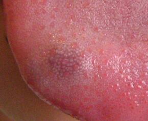 我侄儿舌头上有一个紫红色的东西,会是血管瘤吗?