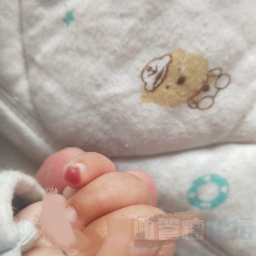 请大家看看这是宝宝手指上的是什么血管瘤_血管瘤论坛-中国血管瘤患者之家
