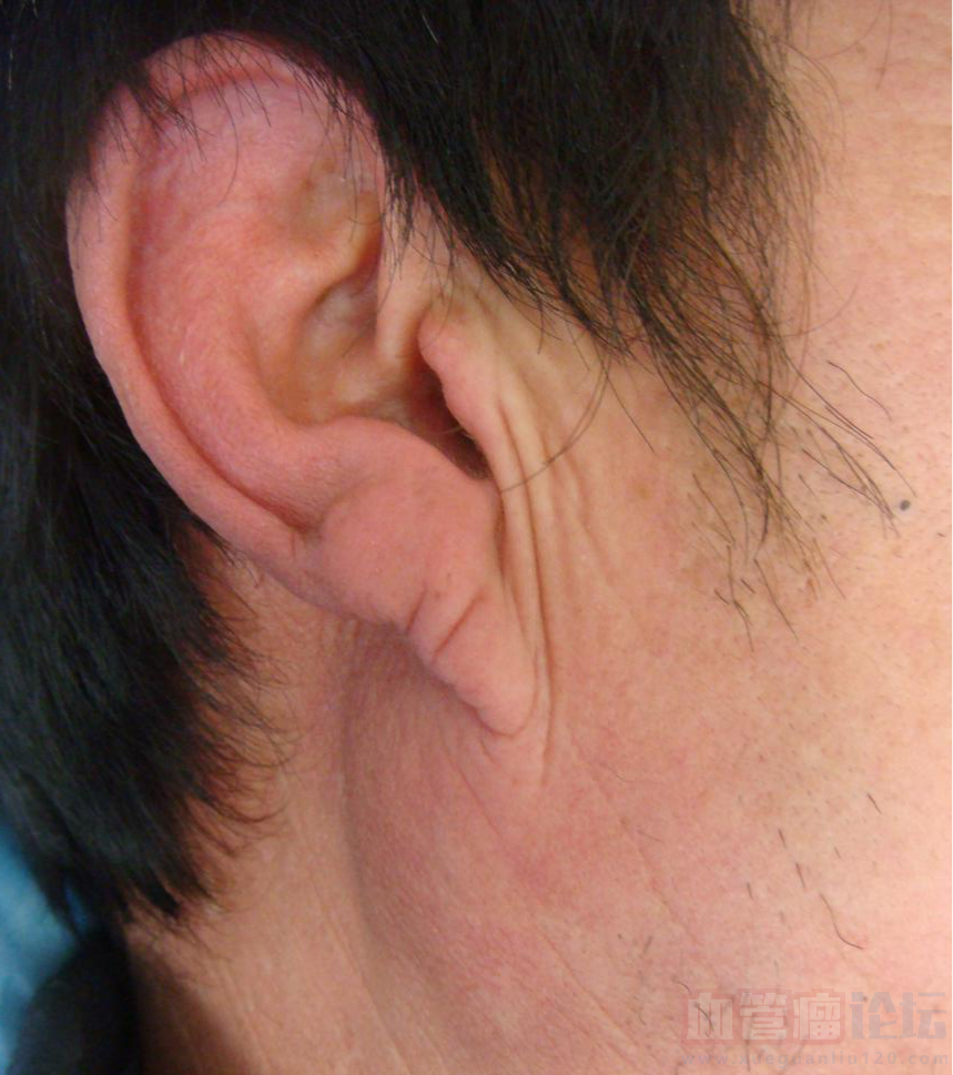 本人42岁，脑右枕部耳朵附近长了一个血管瘤，手术切出后..._血管瘤论坛-中国血管瘤患者之家