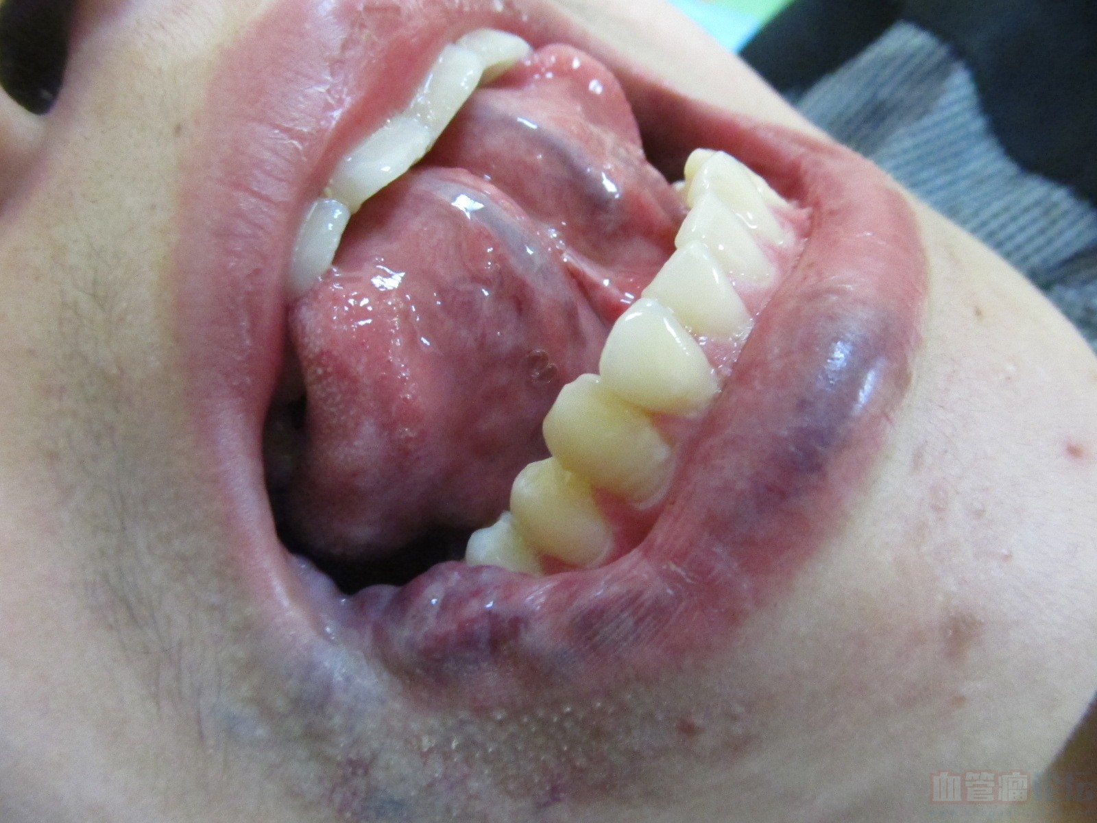 舌根血管瘤图片
