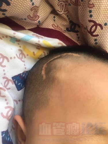 侄儿今年9岁 男孩 出生时就带有血管瘤（出生后去过几个..._血管瘤论坛-中国血管瘤患者之家
