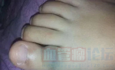 大家帮我看看脚趾这个是不是血管瘤_血管瘤论坛-中国血管瘤患者之家