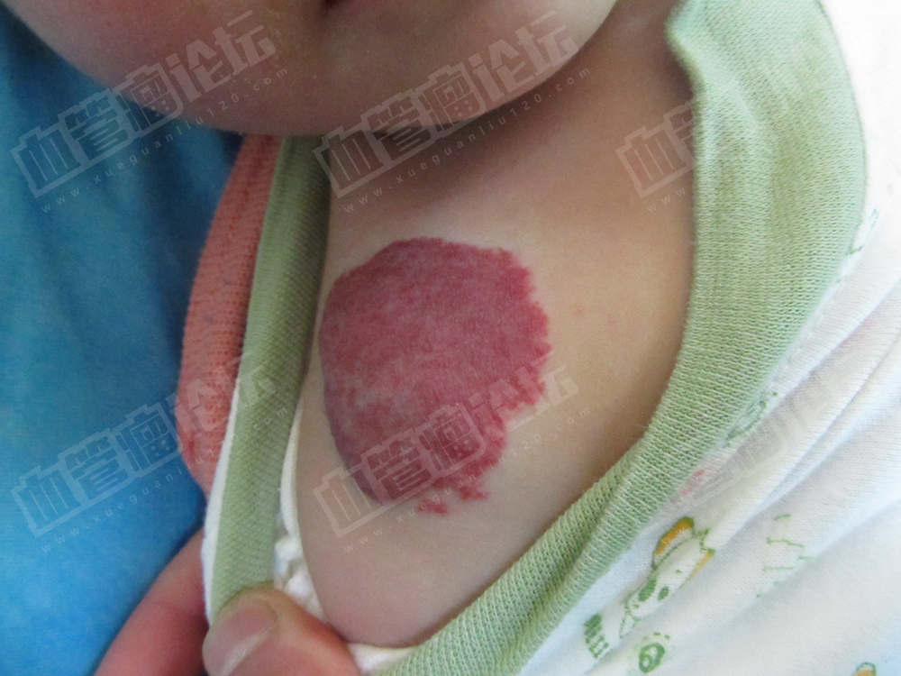 婴儿肩部毛细血管瘤治疗日记