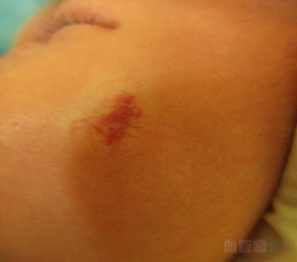 孩子现在两个月，血管瘤长在面部，以前很小现在有硬币..._血管瘤论坛-中国血管瘤患者之家