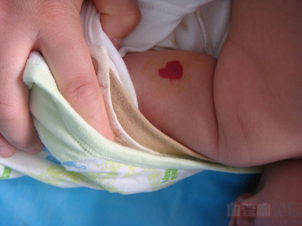 宝宝小腿上有处红红的像胎记一样，用手按不见了放开又..._血管瘤论坛-中国血管瘤患者之家