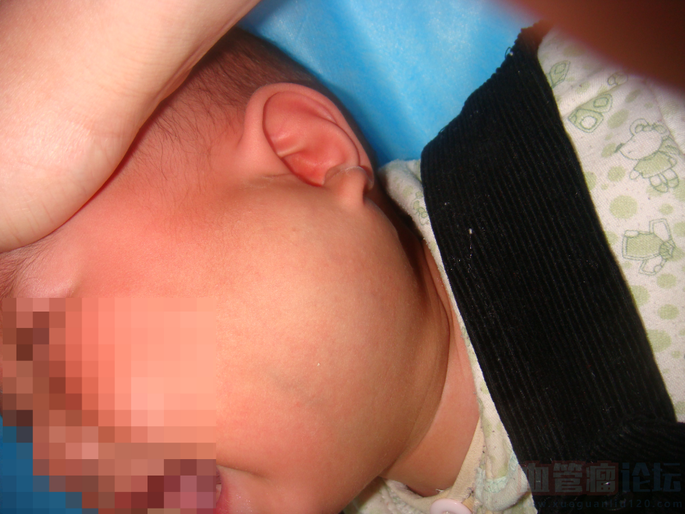 孩子现在九个月，左耳垂下面有红色、肿，医生诊断是腮..._血管瘤论坛-中国血管瘤患者之家