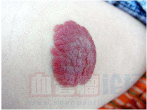 草莓状血管瘤有哪些症状？_血管瘤论坛-中国血管瘤患者之家