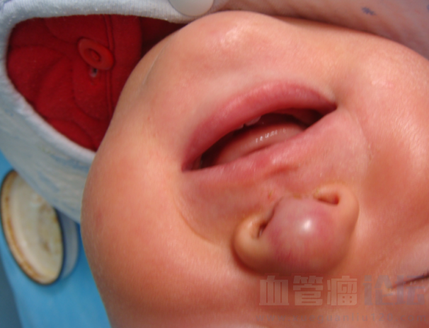 我家宝宝鼻尖上有一块红色的，是毛细血管瘤吗？_血管瘤论坛-中国血管瘤患者之家