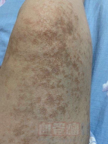 最近才知道自己腿上的是血管痣，30年了，面积很大，还有治疗希望吗？_血管瘤论坛-中国血管瘤患者之家