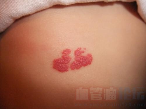 你真的了解婴儿血管瘤吗？_血管瘤论坛-中国血管瘤患者之家