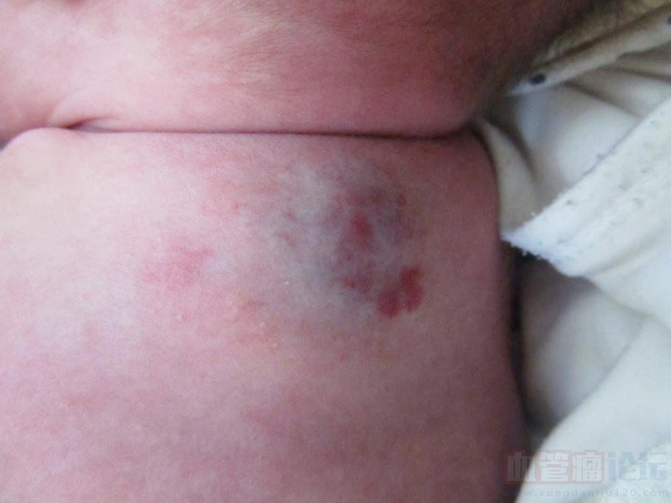 宝宝出生两个月后背右侧长了血管瘤，除了手术治疗还有..._血管瘤论坛-中国血管瘤患者之家
