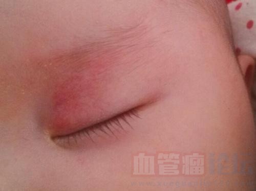 婴幼儿脸上长的红斑是血管瘤吗？血管瘤严重吗？_血管瘤论坛-中国血管瘤患者之家