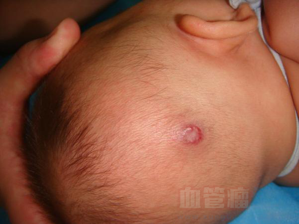 宝宝头皮上的这个是血管瘤吗？_血管瘤论坛-中国血管瘤患者之家
