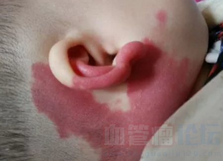 鲜红斑痣的发病原因是什么？_血管瘤论坛-中国血管瘤患者之家