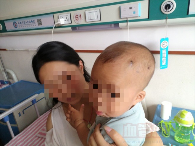 1岁宝宝身患海绵样血管瘤_血管瘤论坛-中国血管瘤患者之家
