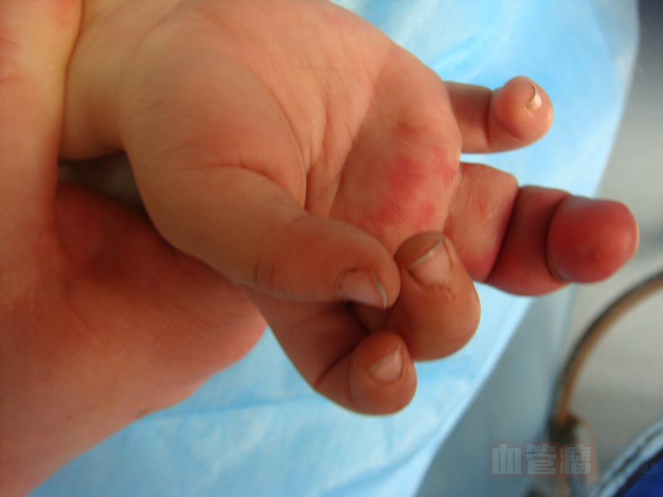 宝宝出生的时候手指有一个红色疙瘩，请问会是血管瘤吗？_血管瘤论坛-中国血管瘤患者之家