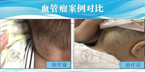 7个月宝宝颈后富贵包竟然是血管瘤_血管瘤论坛-中国血管瘤患者之家