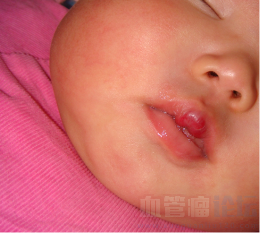 我家宝宝嘴唇上有个红包，目前还不知道是不是血管瘤_血管瘤论坛-中国血管瘤患者之家