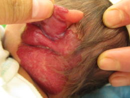 宝宝耳后血管瘤怎么治疗_血管瘤论坛-中国血管瘤患者之家