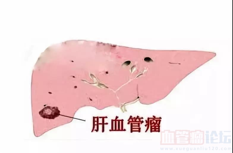 肝血管瘤不要慌多数不用治_血管瘤论坛-中国血管瘤患者之家