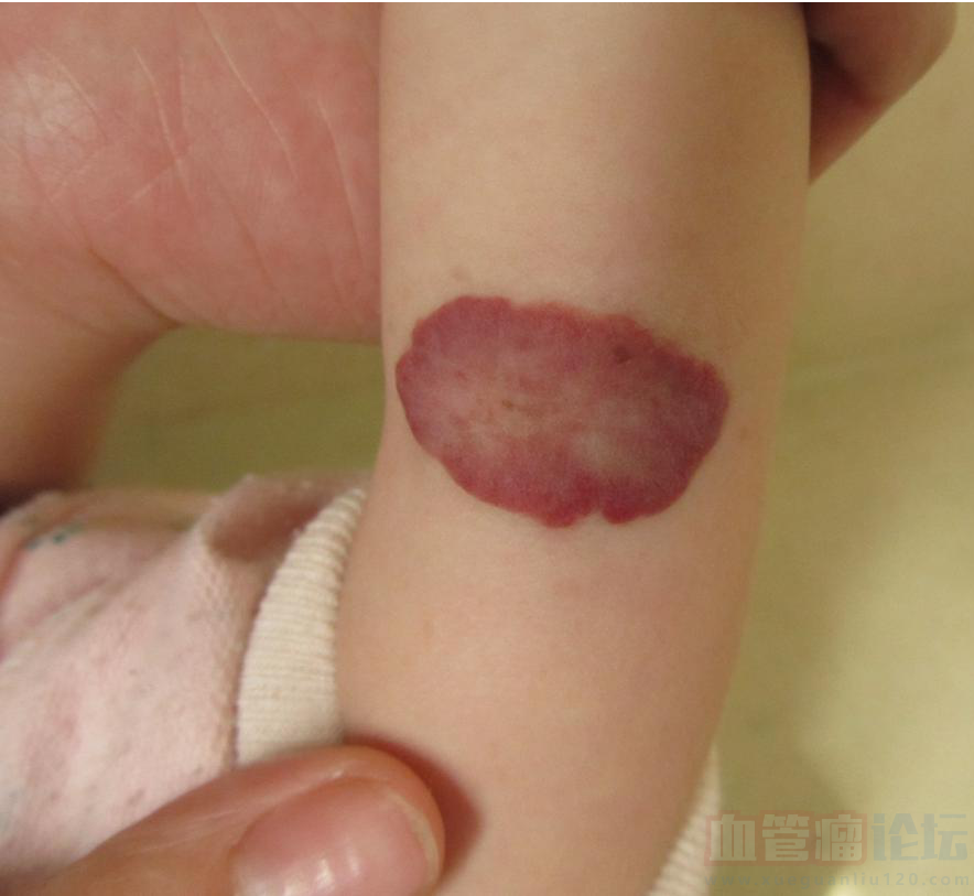 这种草莓状血管瘤可以涂眼药水不？_血管瘤论坛-中国血管瘤患者之家