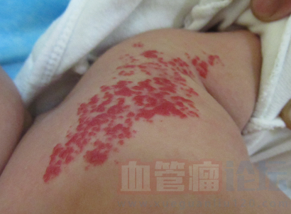 血管瘤对小儿的危害_血管瘤论坛-中国血管瘤患者之家