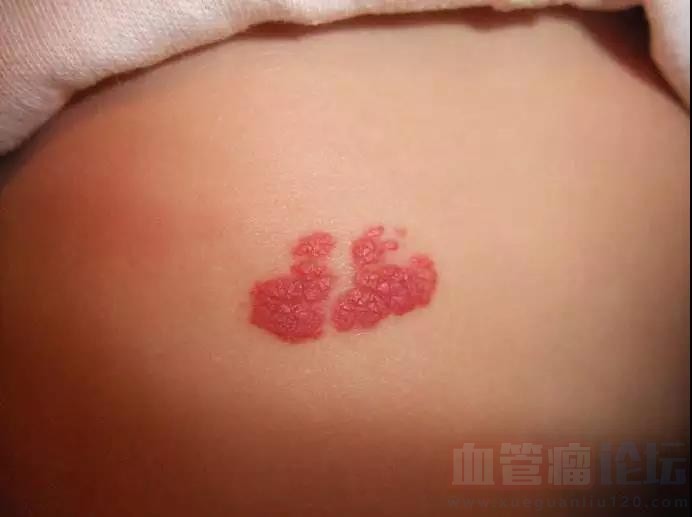 孩子出生有红色胎记要小心血管瘤_血管瘤论坛-中国血管瘤患者之家