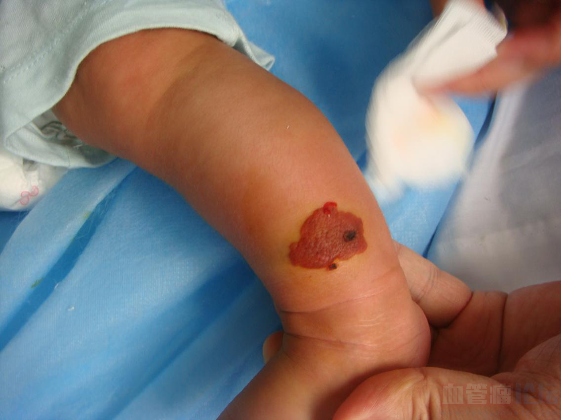 我儿子刚出生不久，医生说手腕上有一个血管瘤，想问一..._血管瘤论坛-中国血管瘤患者之家