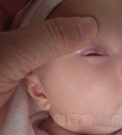 我家宝宝眼睛上长了血管瘤，眼睛上的血管瘤好治吗？_血管瘤论坛-中国血管瘤患者之家