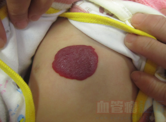 宝宝背上有血管瘤咋整啊？_血管瘤论坛-中国血管瘤患者之家