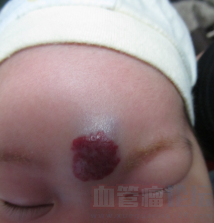 宝宝额头上长了血管瘤，要是不治疗的话影响大不大啊_血管瘤论坛-中国血管瘤患者之家