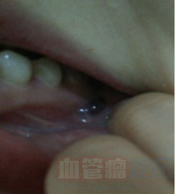 患者，女，二十一岁，口腔里长了血管瘤，有一年多了_血管瘤论坛-中国血管瘤患者之家