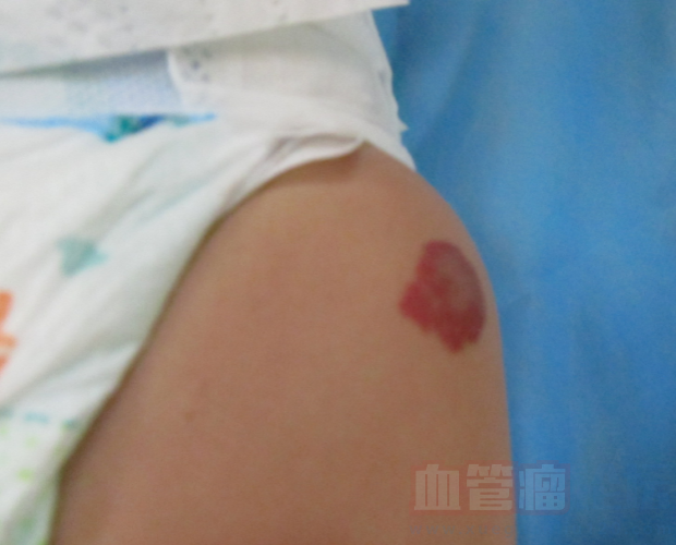 求助，3个月的宝宝这个情况是什么类型的血管瘤！_血管瘤论坛-中国血管瘤患者之家