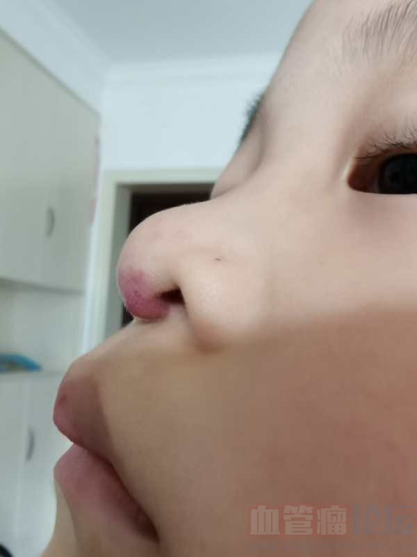 谨防小孩鼻尖血管瘤破裂_血管瘤论坛-中国血管瘤患者之家