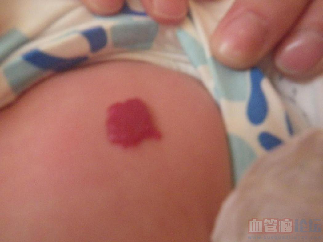 孩子生下来发现身上有血管瘤，想帮他早点治疗，婴儿血..._血管瘤论坛-中国血管瘤患者之家