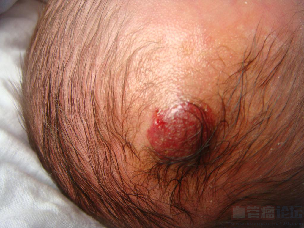我家宝宝出生的时候额头没有异常，后来发现有一个血管瘤_血管瘤论坛-中国血管瘤患者之家
