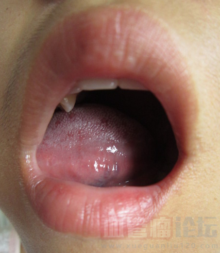 小儿舌部血管瘤，各位求治疗方案_血管瘤论坛-中国血管瘤患者之家