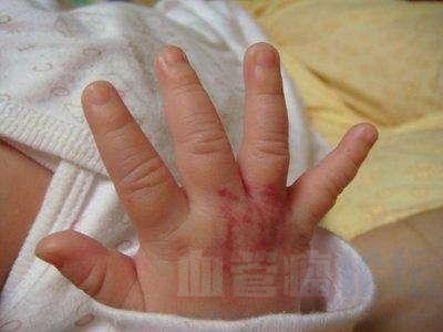 手指血管瘤症状有哪些?微创介导治疗的原理是什么?_血管瘤论坛-中国血管瘤患者之家