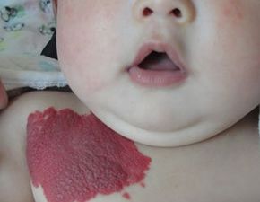 婴幼儿血管瘤（草莓状血管瘤）是什么呢?会遗传吗?_血管瘤论坛-中国血管瘤患者之家