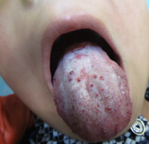 我家孩子舌头上的是血管瘤吗？_血管瘤论坛-中国血管瘤患者之家