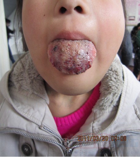 我女儿舌头上面红红一片想问问舌头癌与血管瘤的区别