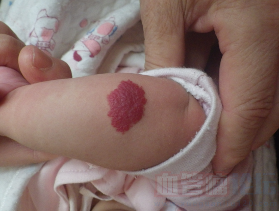 这是什么类型的血管瘤，长得很快，在孩子手肘上_血管瘤论坛-中国血管瘤患者之家